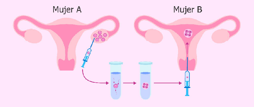 Proceso del Método ROPA (Recepción de Óvulos de la Pareja)